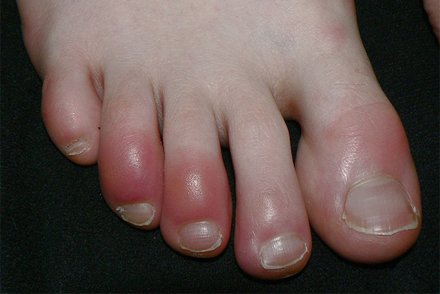 covid toes