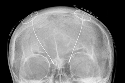 Deep-brain stimulator probes shown in an X-ray of the skull