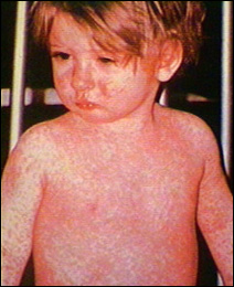 A child with rash of measles.